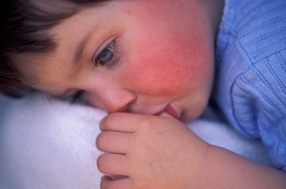  Rosy cheeks are one of the main symptoms of scarlet fever