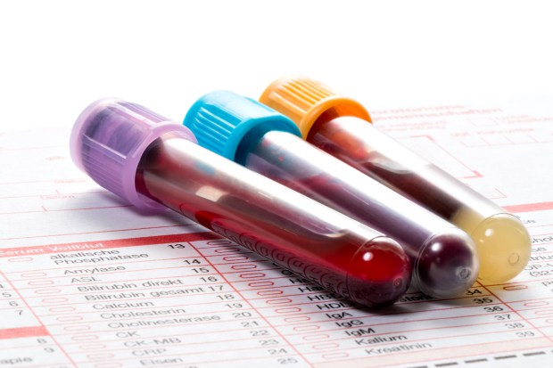 A simple blood test may revolutionise diagnosis and treatment