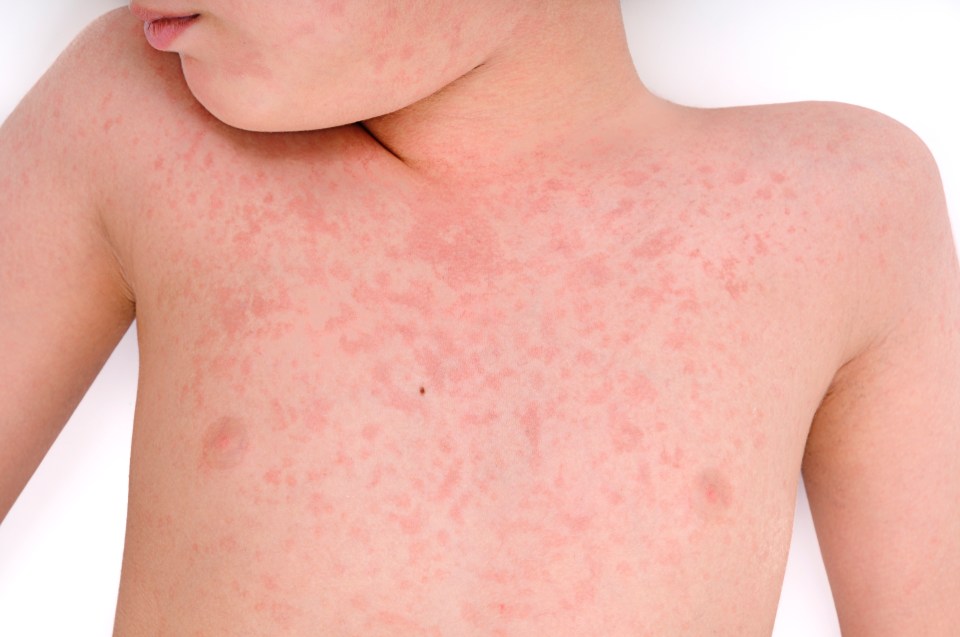  A French boy was taken to see a doctor in Costa Rica who confirmed he had measles (stock image)