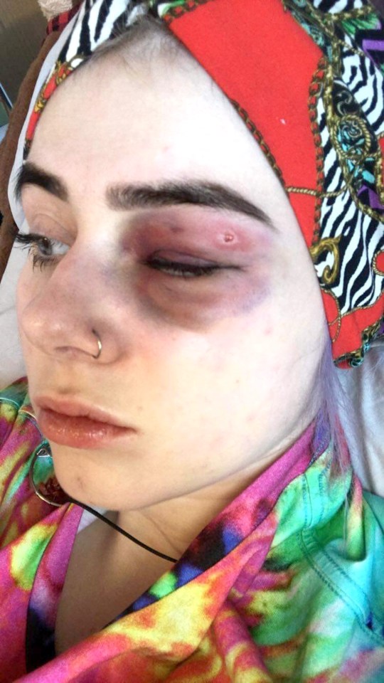 Her bruising is so severe that teachers and nurses have asked whether she's being abused at home