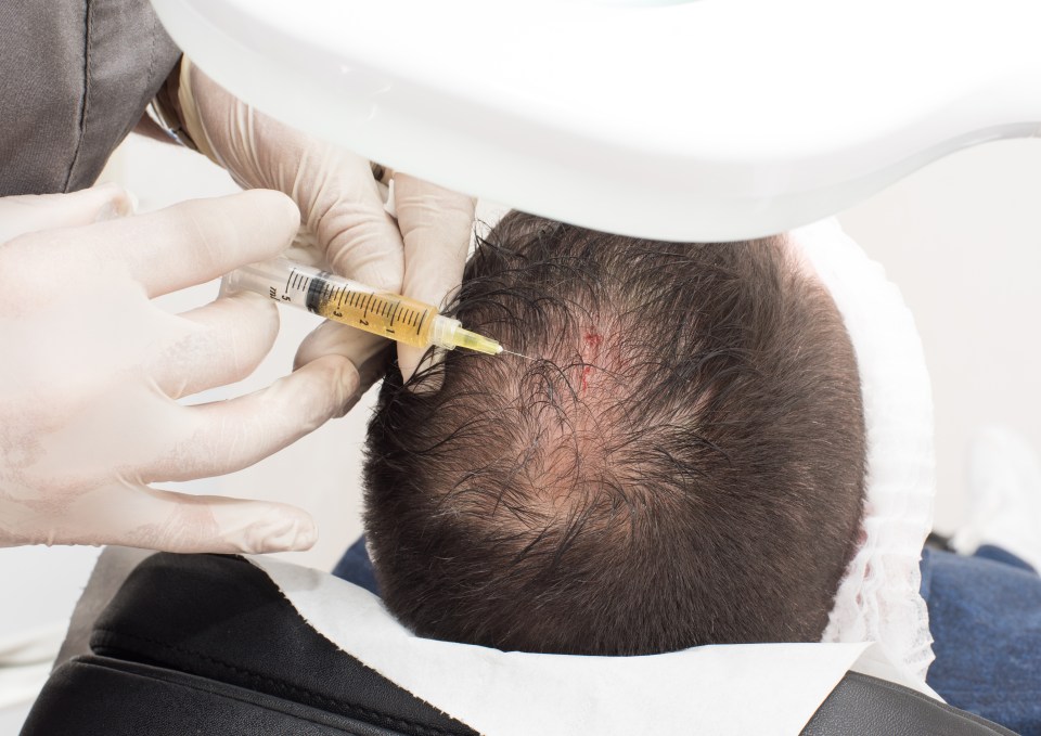  The plasma is then injected into the scalp to stimulate follicle regeneration