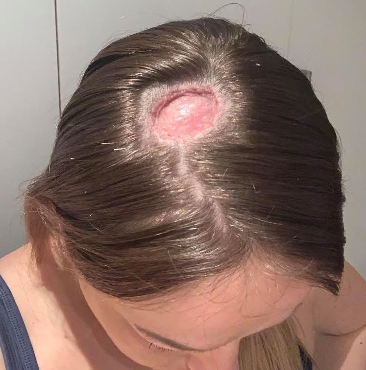 Nickie's head just two weeks after having the cancer removed from her scalp