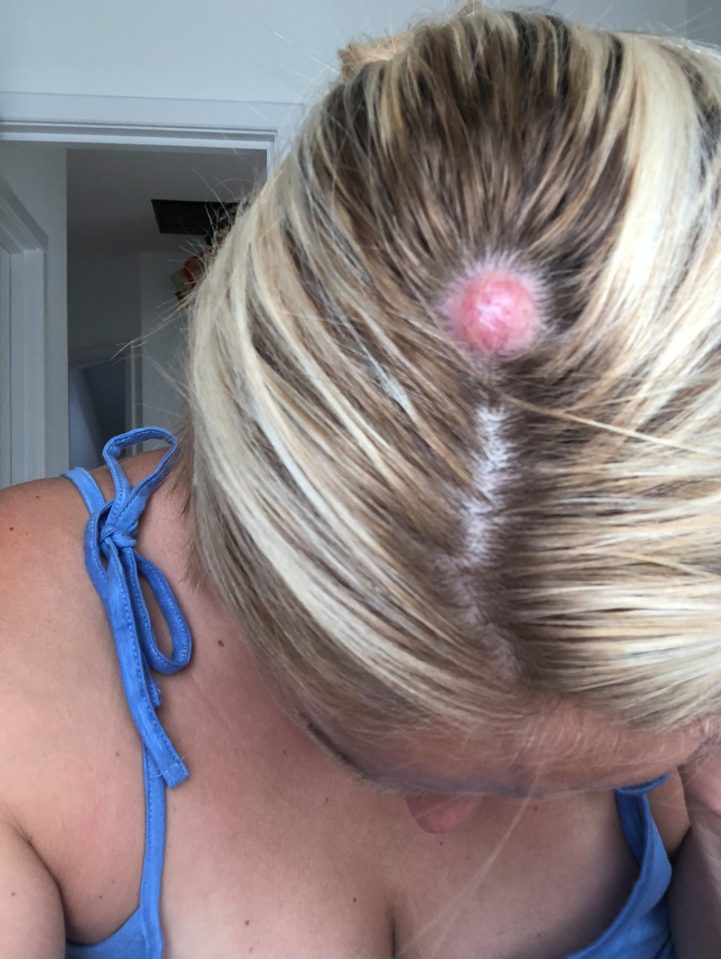 The 'cyst' on top of Nickie's head before surgery