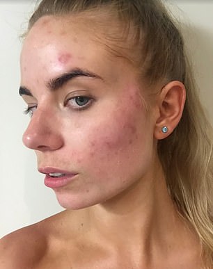  The blogger says sometimes she wouldn't leave the house because of her skin