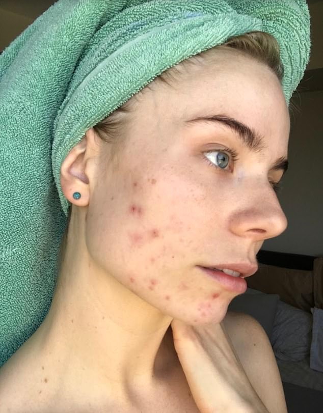  Nicola's cystic acne began when she changed contraceptive pill