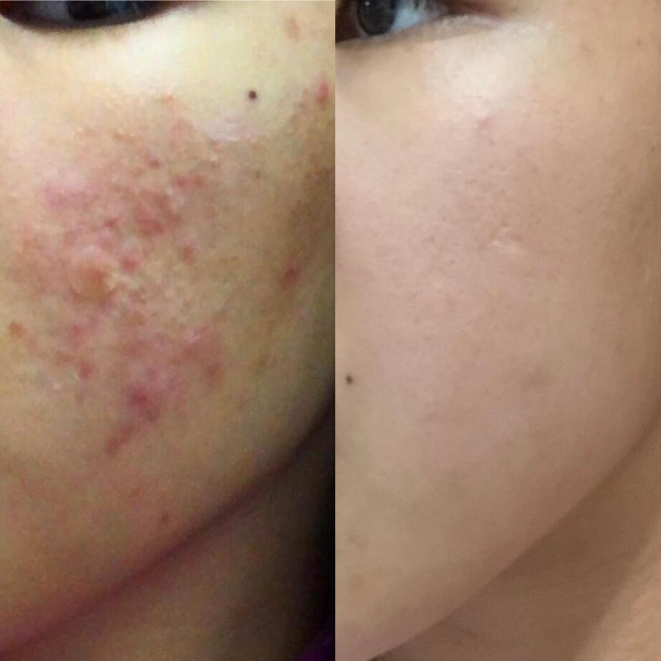  Reddit user ricebowlmama has revealed her dramatic skin transformation after she stopped exfoliating