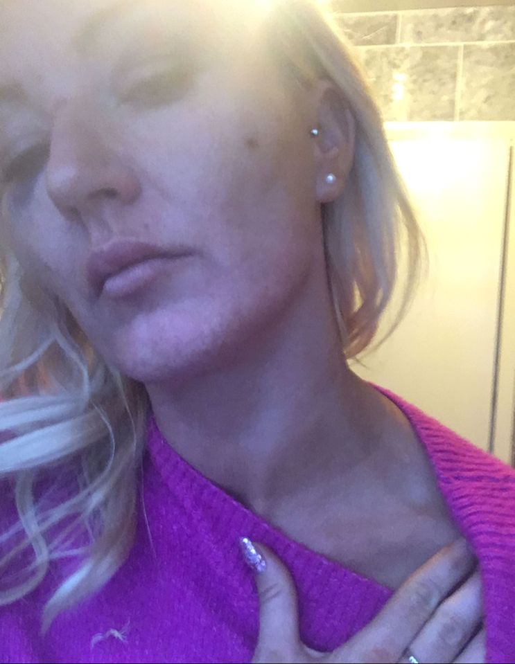  Lyndsey shows off damage to her neck