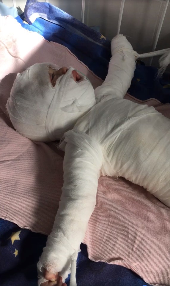 Daniil Chernenko suffered horrific burns to most of his body after falling into a bucket of boiling hot water in Ukraine