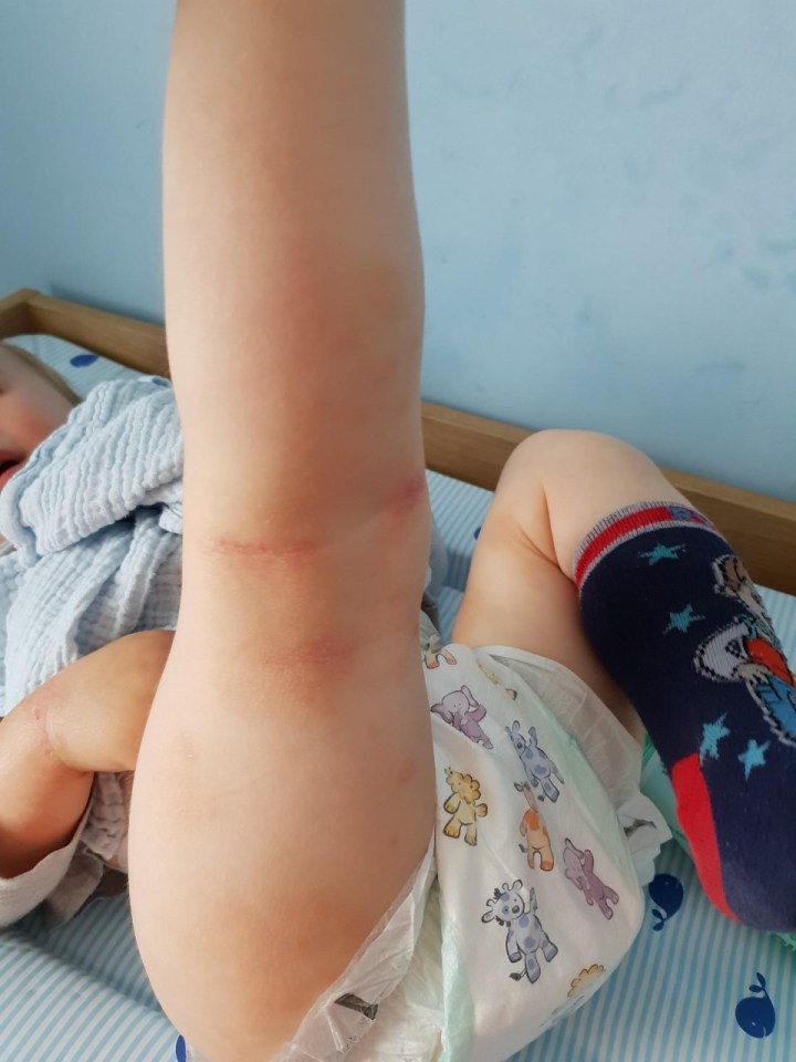  Nikki started taking her son to the doctors when he first showed signs of eczema at just a few months old - but said none of the creams they were given worked