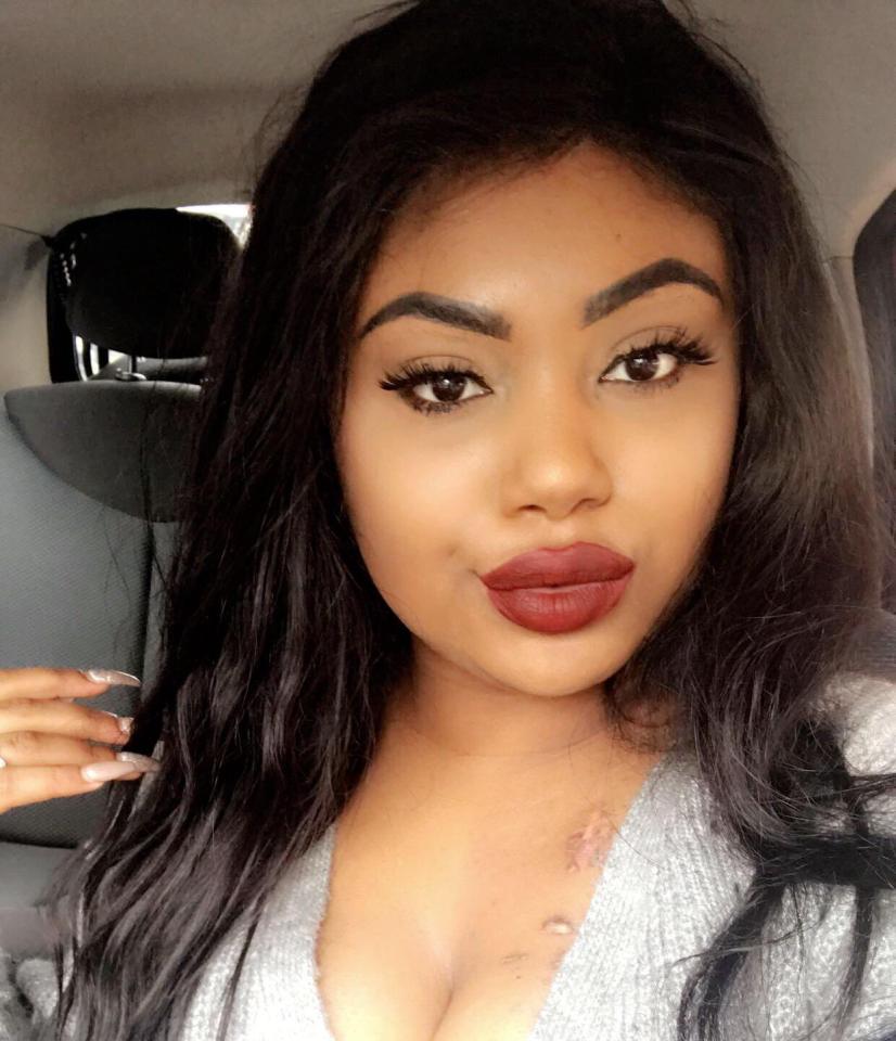 Monae Paris-Davis lip fillers