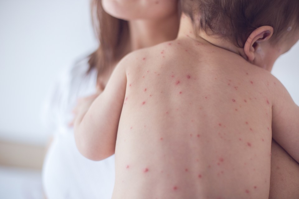 Some 285 cases of the measles have been confirmed in New York since October