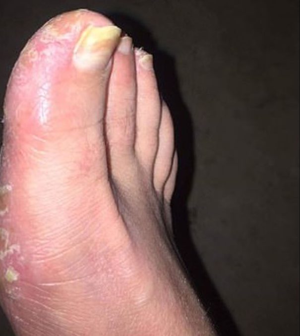  Doctors say the stress of her daughter's illness triggered the psoriasis outbreak which left her unable to walk due to blisters on her feet