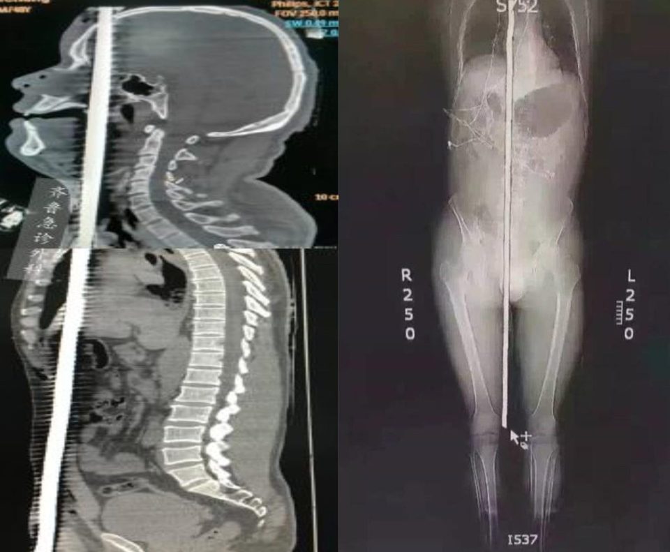 This shocking CT scan shows how the metal bar impaled the man through his body piercing his groin and coming out of his head