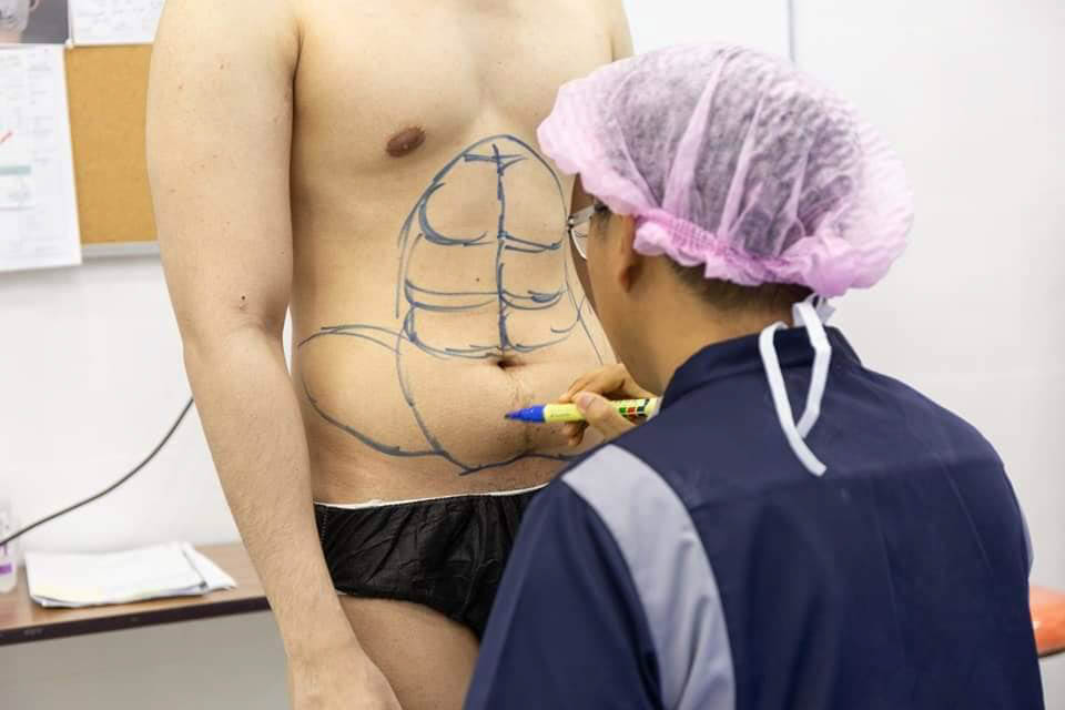  The 'abdominal etching' procedure has surged in popularity recently