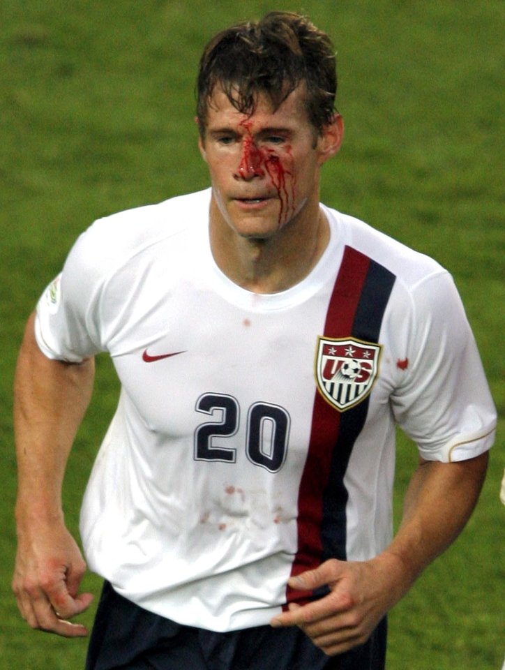 A stray elbow from De Rossi left USA star Brian McBride's face bloodied