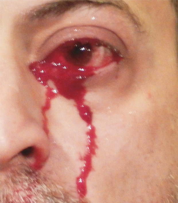  The 52-year-old man's eyes would start bleeding spontaneously, which would last for a few minutes at at time