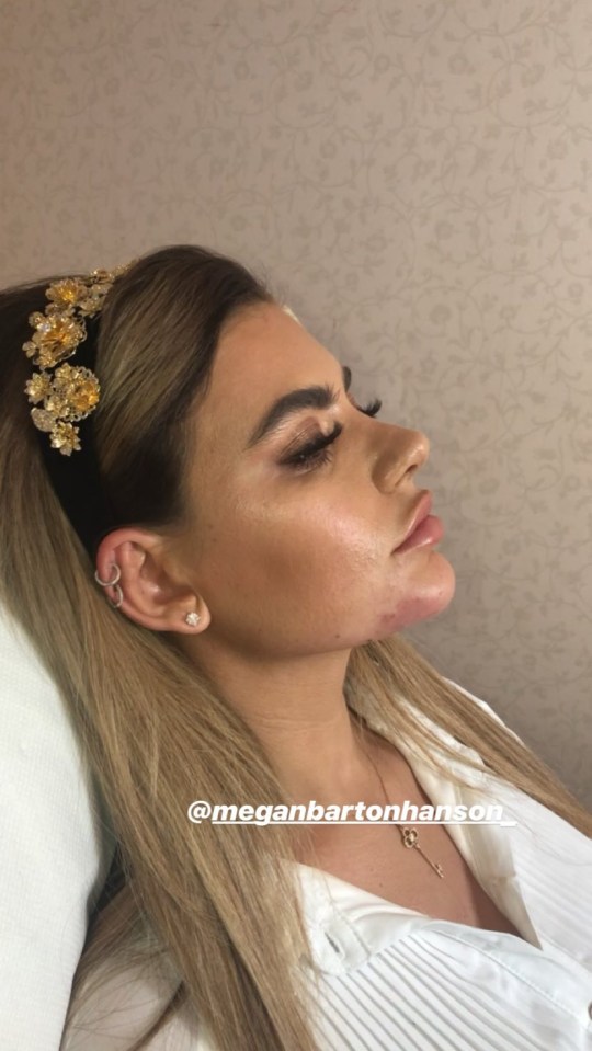 The reality star underwent the cosmetic procedure to give her a perfect jawline