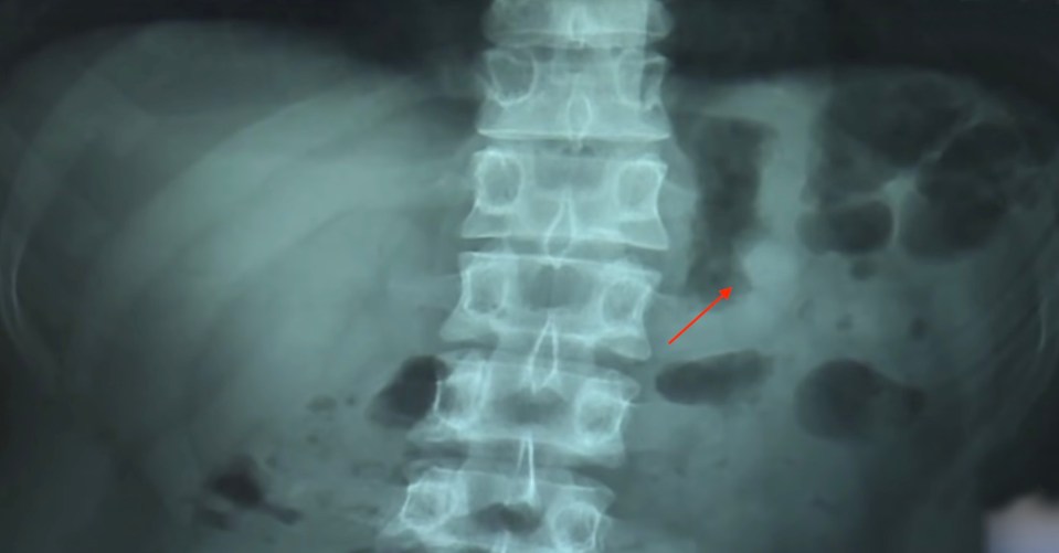  X-Ray scans show the AirPod sitting in the man's stomach