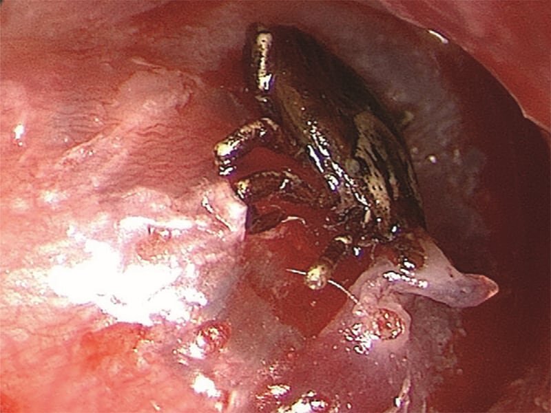 Docs found a tick buried into the boy's eardrum