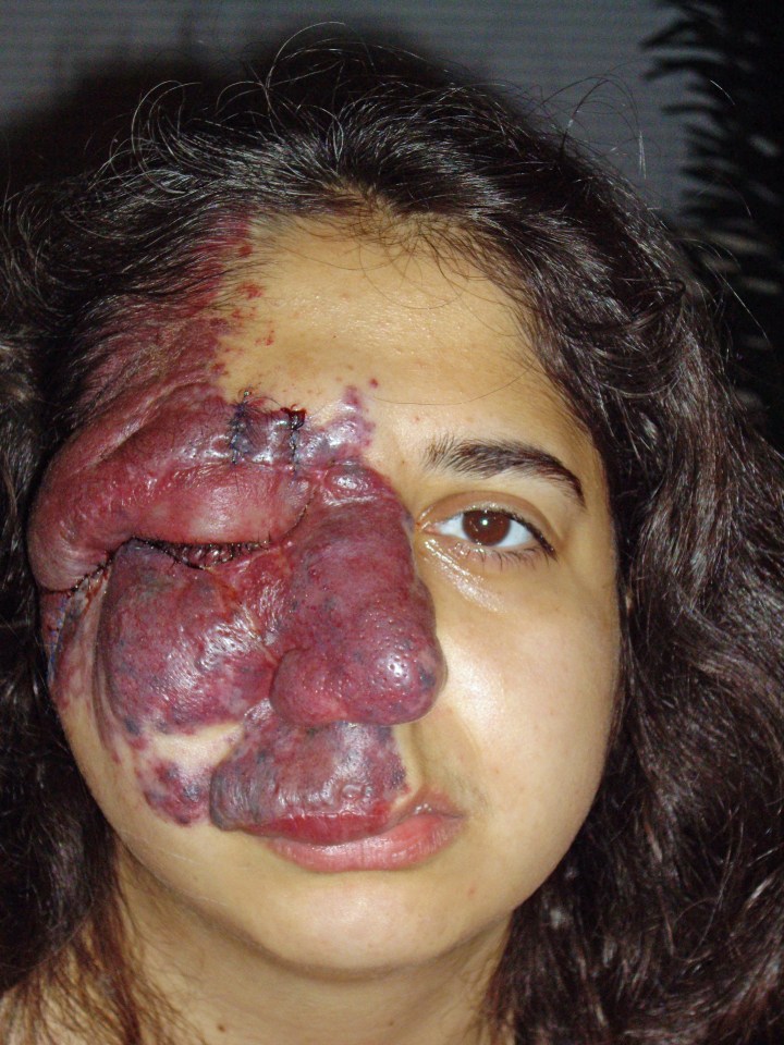 Ellahe Haghani was born with Sturge-Weber syndrome