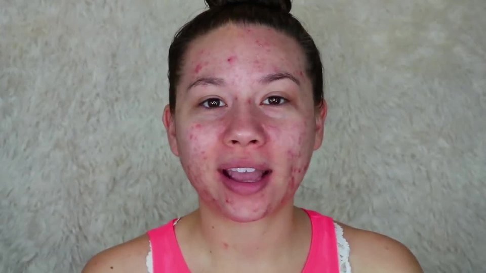  YouTuber Shweihninzy suffers from severe acne