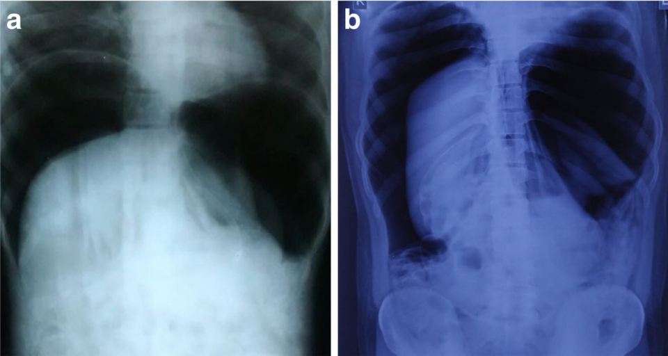  Abdominal X-rays showing air inside the abdomen of the 24-year-old case who had an accidental injury