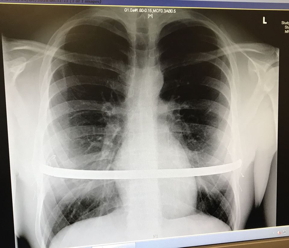  David had a curved metal bar placed underneath his sternum and attached to both sides of his rib cage with wire and pins to force the bones back into their correct position