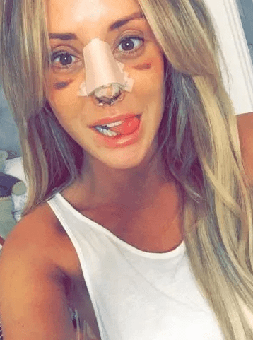  Charlotte previously had a nose job