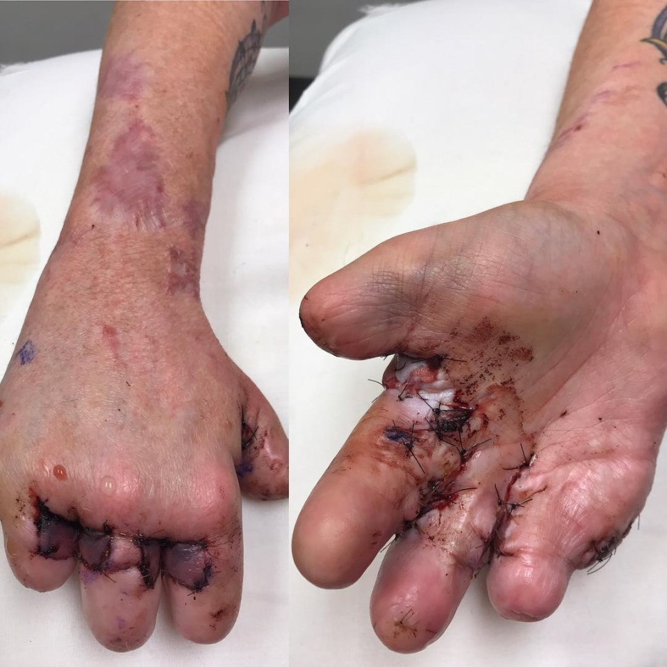  She had to have parts of her fingers amputated after the tissue died