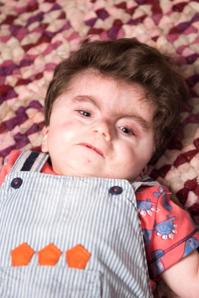  Noah, one, has Cornelia de Lange syndrome - a rare genetic disorder which can delay development