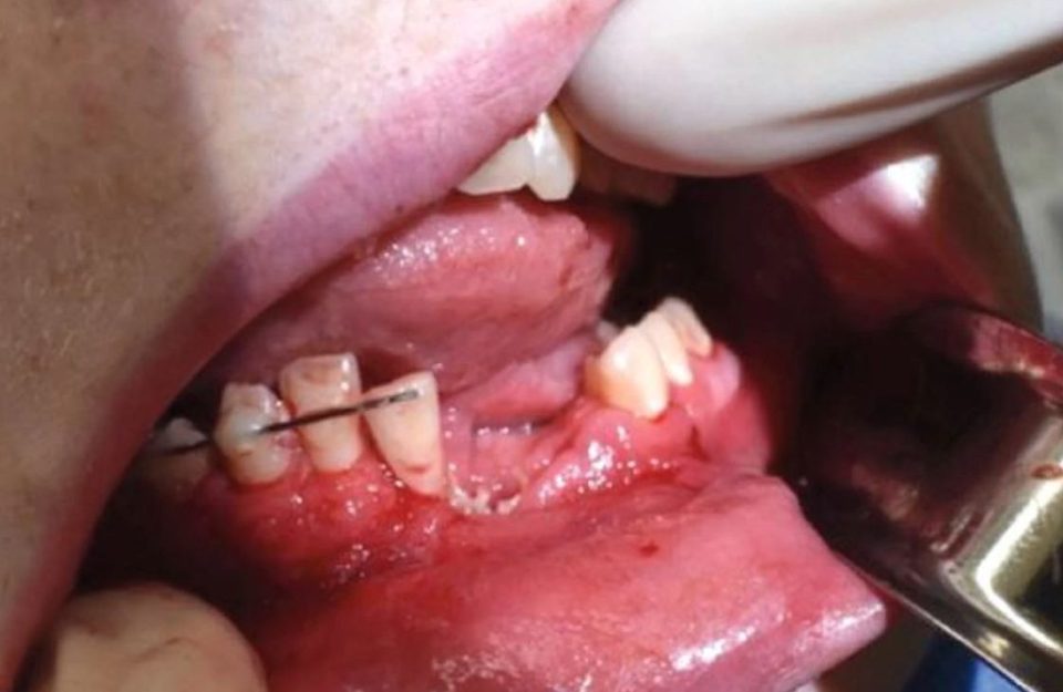  A 17-year-old boy's teeth were blown out after his e-cigarette exploded in his mouth