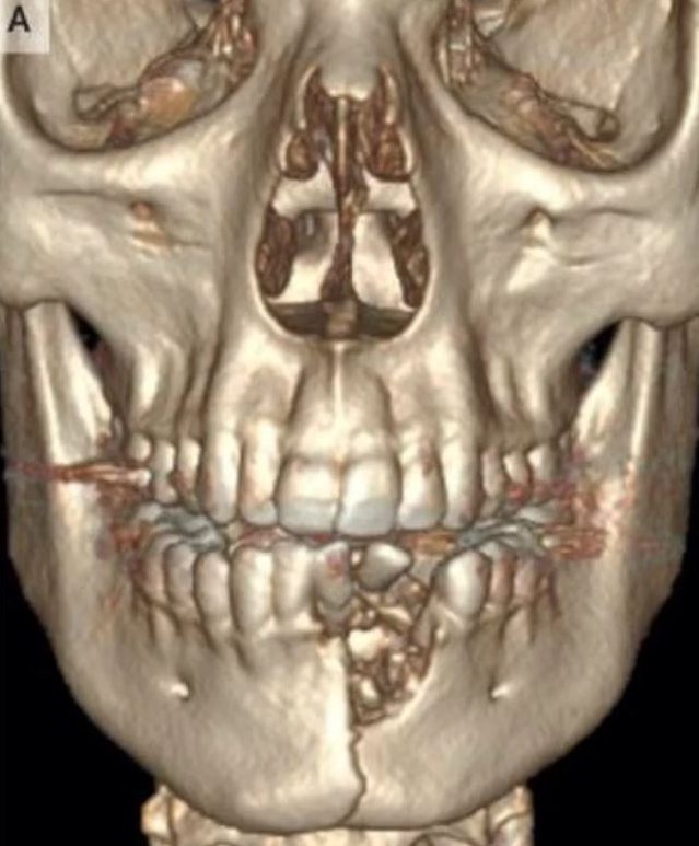  A CT scan of the 17-year-old boy, showing his shattered jaw and displaced teeth