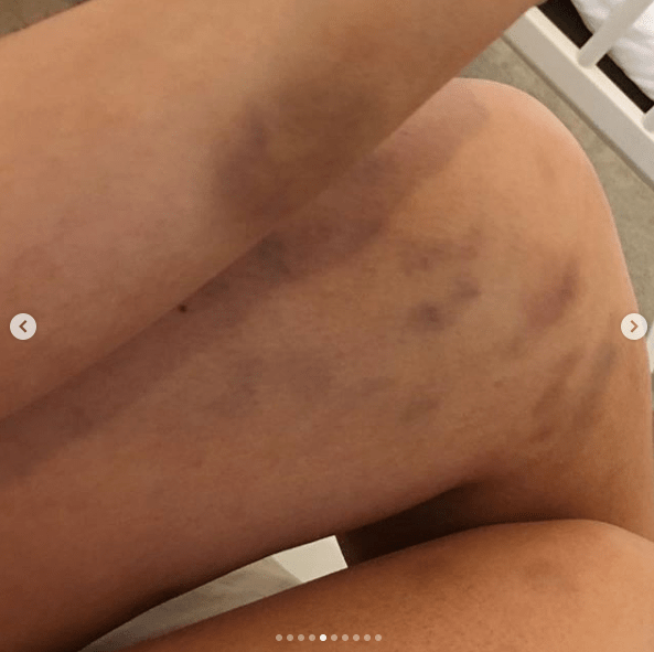  Steph's purple knees and arms after a fight with her ex