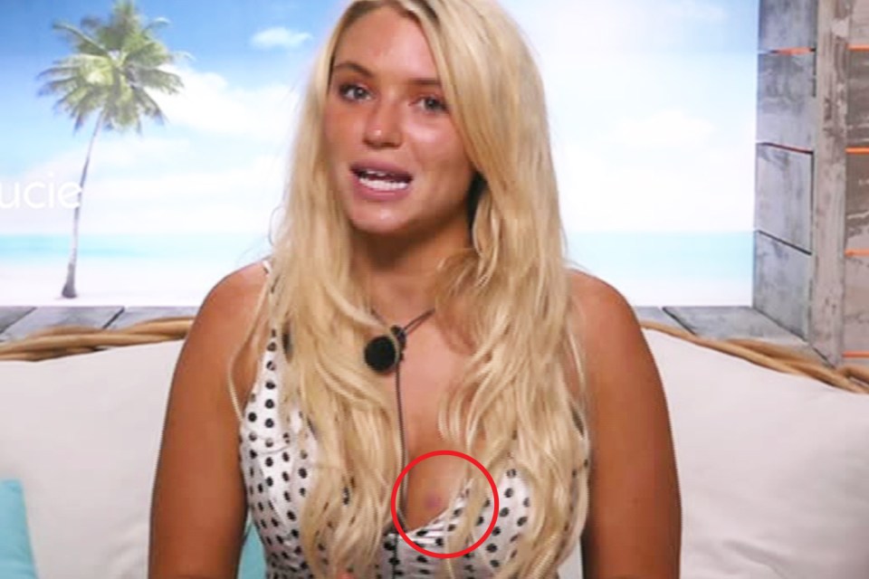  The apparent hickey was spotted on Lucie's chest when she opened up about George in the Beach Hut