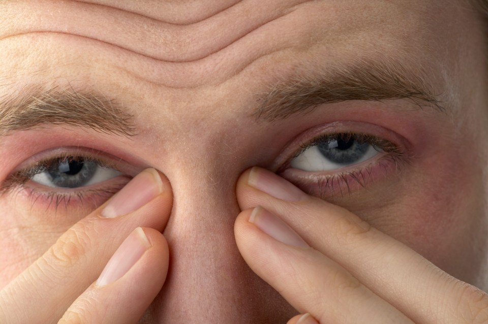 Stop using your contact lenses if you suffer from hay fever - you'll only make your symptoms worse 