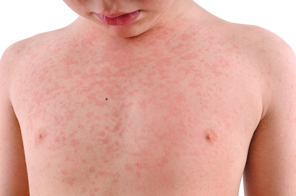 Children are more prone to prickly heat because their sweat glands are not fully developed