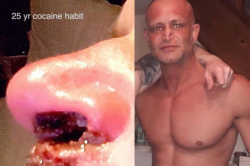  Ian Higginson had a £400-a-week cocaine habit for 25 years and has shared photos of the effect it had on his nose