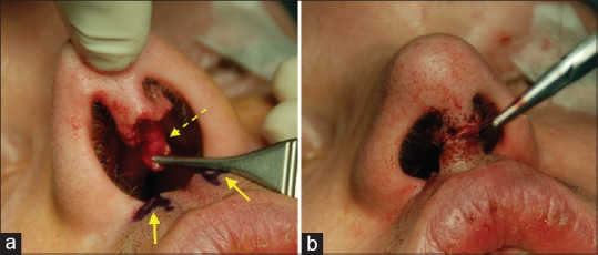  Coke nose reconstruction surgery is a lengthy, and painful, process which often takes years and operations