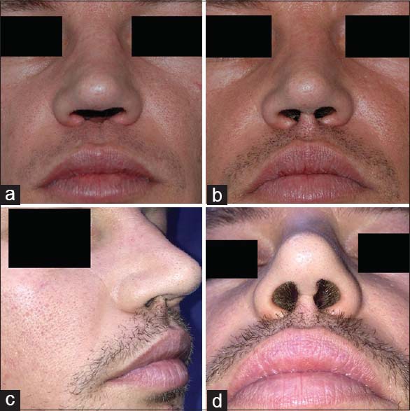  This 32-year-old man needed cosmetic surgery to repair his nose after cocaine use. Photo (a) shows the result six months after one op, with photo (b) taken two years later. (c) and (d) offer other views