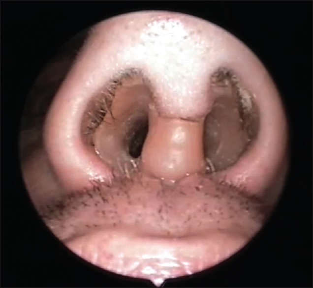 This image is of a cocaine user who needed a Columella reconstruction with a prosthesis