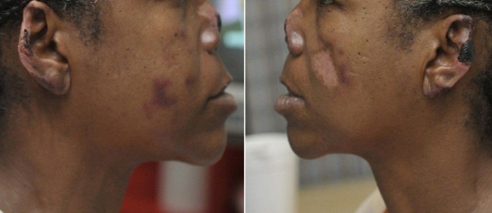  The extent of damage to the woman's nose caused by the cattle dewormer, which cocaine can be cut with, is clearly visible