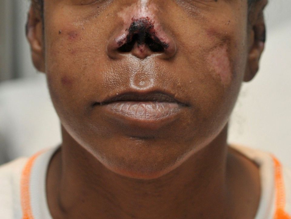  This woman was a cocaine abuser who suffered rotting flesh because of Levamisole