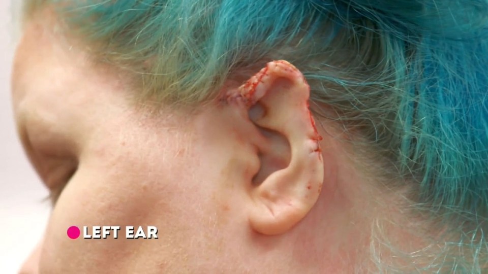 The operation wasn't straight forward and resulted in Jennifer having to have her ear reconstructed using a skin graft