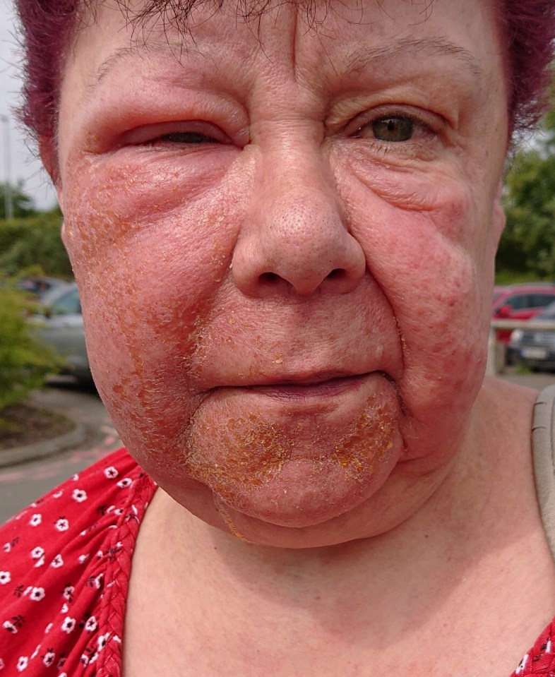  Tracey had to go to hospital after her face ballooned and broke out in blisters