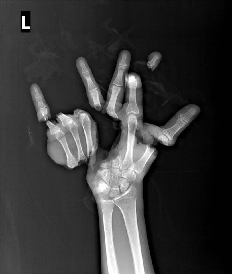  An X-ray of the man's hand shows how badly injured it was - before being incredibly pieced back together