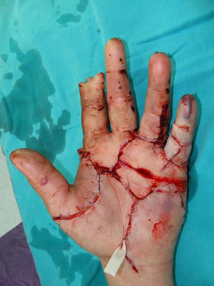  The victim suffered horrific injuries after getting caught in the huge pressing machine used to crush waste