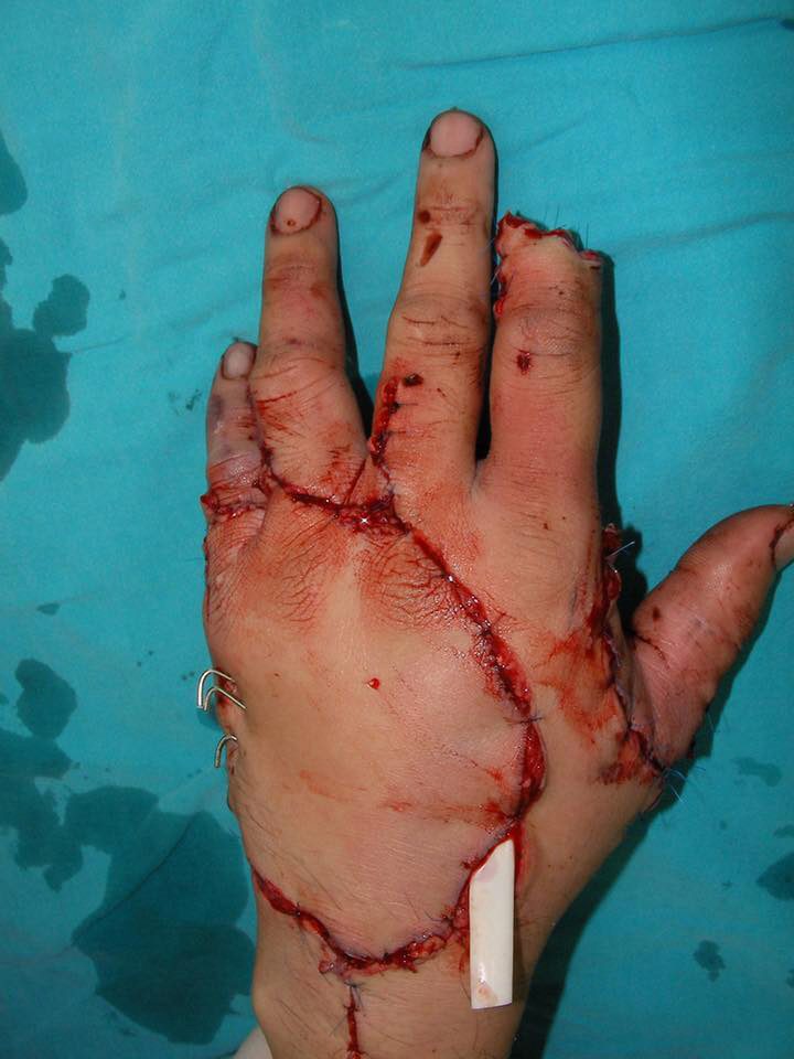  These graphic images show how the surgeons managed to carefully sew his hand up after severing it badly