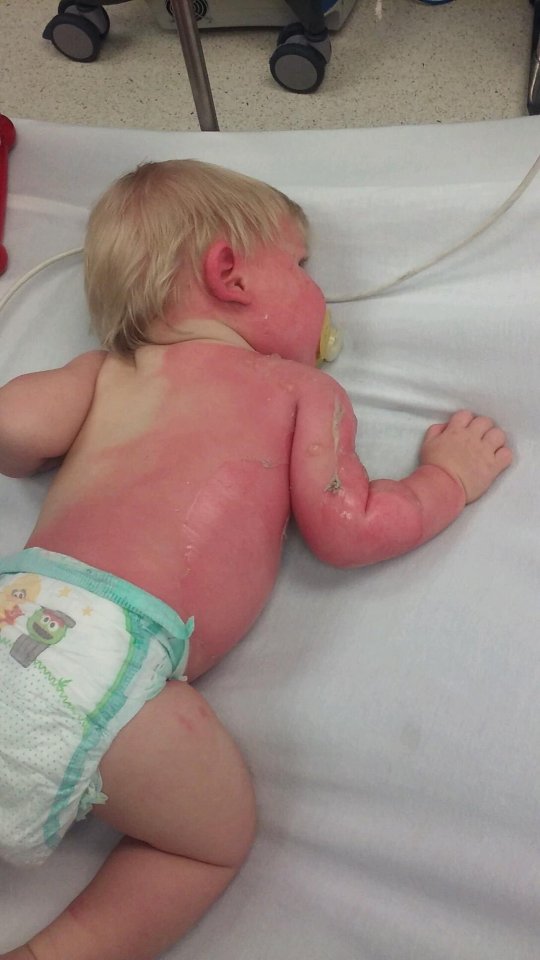  The nine-month-old suffered second-degree burns over 30 per cent of his body