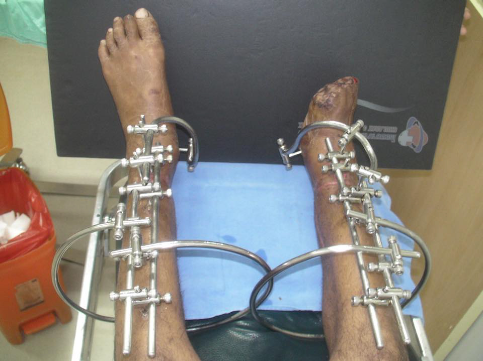  The patient was left with a metal frame - internally and externally - to help his bones heal