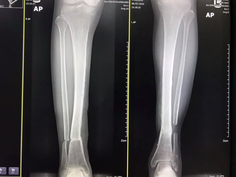  Dr Wichit Siritattamrong, from the Chulalat 3 International Hospital in Bangkok, said three years later his patient has learned to walk again